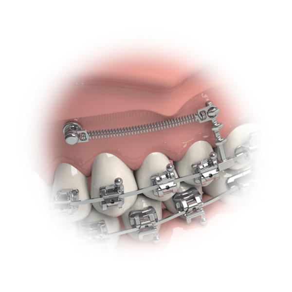 Crimpable Hook For TADs