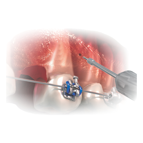 Long Contra-Angle Pick-Up Driver