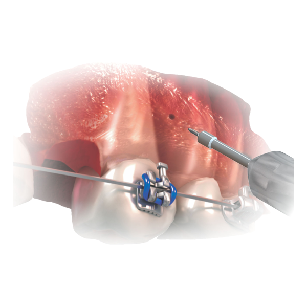 Medium Contra-Angle Pick-Up Driver