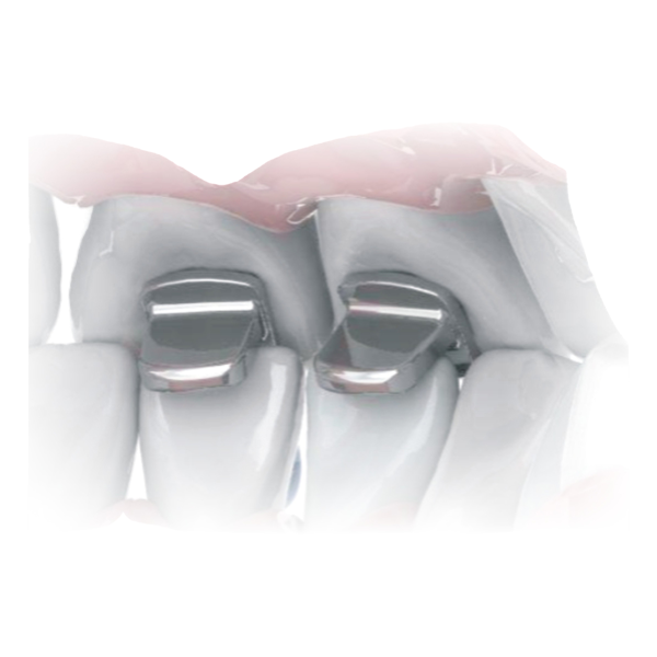 Stainless Steel Bite-Builder