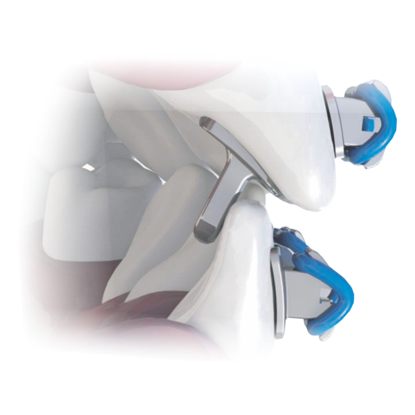 Stainless Steel Bite-Builder