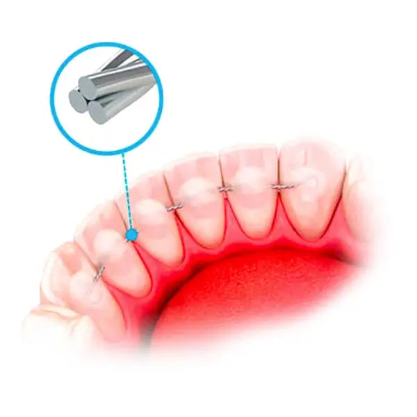 TwistForm Stainless Steel Braided Lingual Retainer